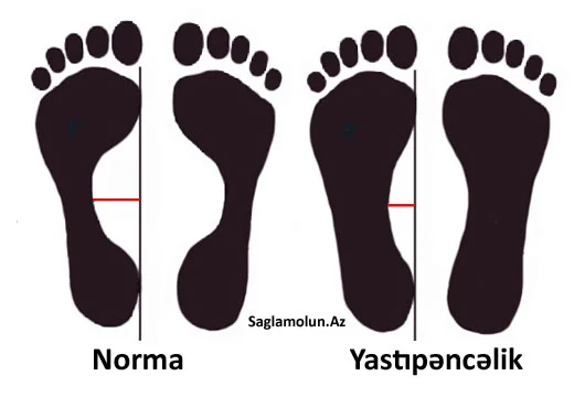 Sizdə yastıpəncəlik var? TESTLƏ YOXLAYIN