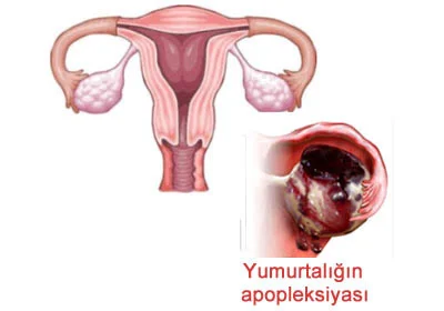 Yumurtalığın yırtılması (yumurtalığın apopleksiyası)