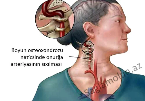 Sizdə boyun osteoxondrozu varmı? TEST