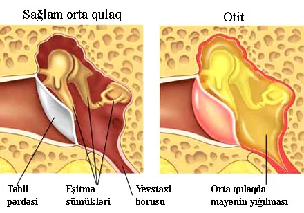 Otit qulaq iltihabı