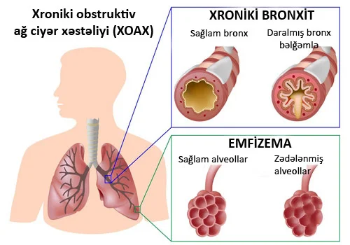 Siqaret çəkənlərin qənimi xroniki obstruktiv ağ ciyər xəstəliyi