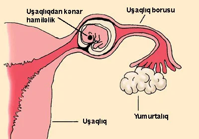 Uşaqlıqdan kənar hamiləklə bağlı olan bəzi yalnış fikirlər