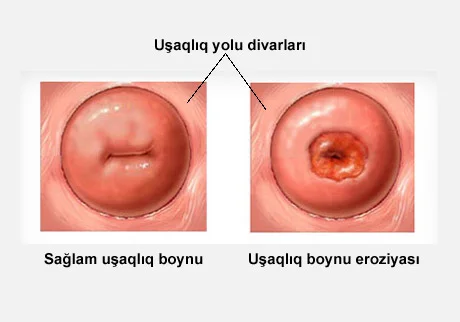 Uşaqlıq boynu eroziyası haqqında yanlış fikirlər