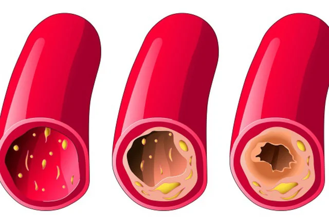 Damarlar nə üçün tutulur? 7 əsas səbəb