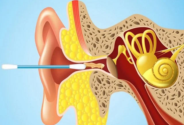 Qulağın içindəki sarı kir əslində faydalıdır Qulaq çöpü ilə təmizləmək ziyandır