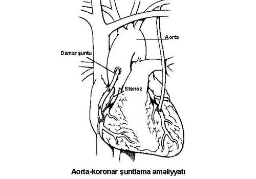 Miokard infarktının müalicəsi