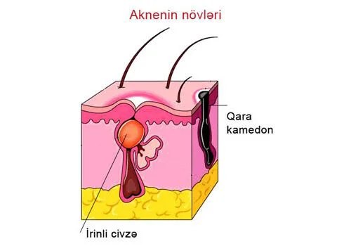 Sızanaqlar niyə əmələ gəlir?