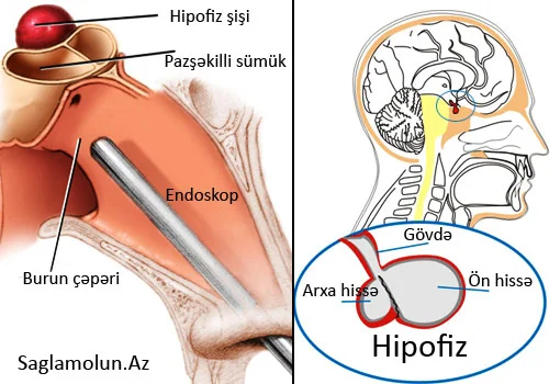 Prolaktinoma hormonal pozulmaların səbəbi