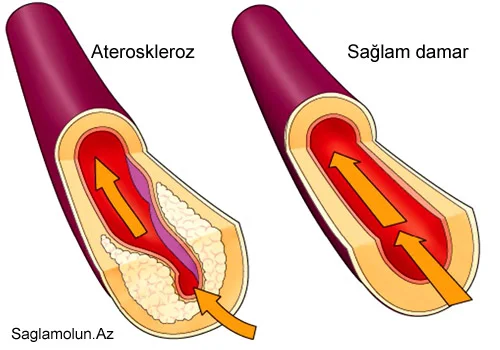 Stenokardiya xəstəliyi. Səbəbləri və müalicəsi