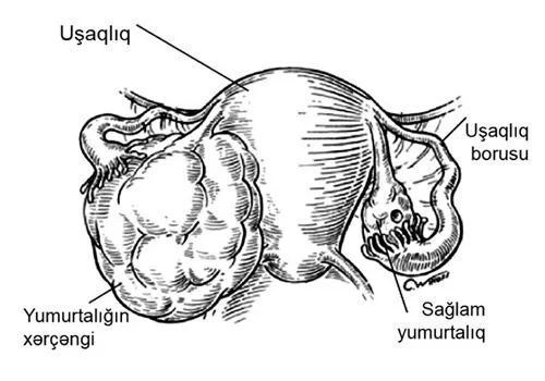 Yumurtalıqların xərçəngi