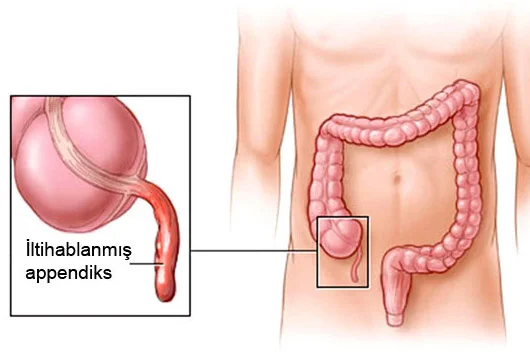 Appendisit və onun ağırlaşmaları