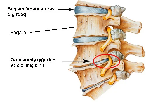 Osteoxondroz və onun müalicəsi