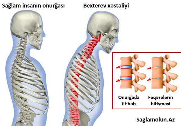 Bexterev xəstəliyi. Hərəkətsiz onurğa