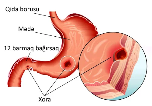 Peptik xora xəstəliyi. RİSK FAKTORLARI