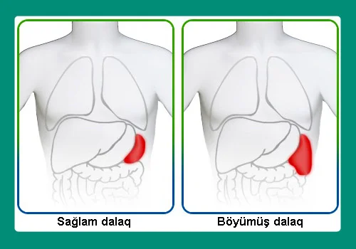 Dalağın böyümə səbəbləri