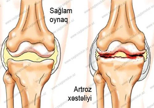 Artroz (osteoartroz)