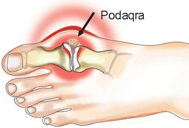 Krallar xəstəliyi PODAQRA. Səbəblər və müalicə