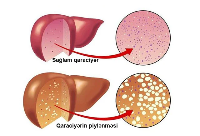 Bu 20qəpiklik məhsul qaraciyərin yağlanmasını azaldır