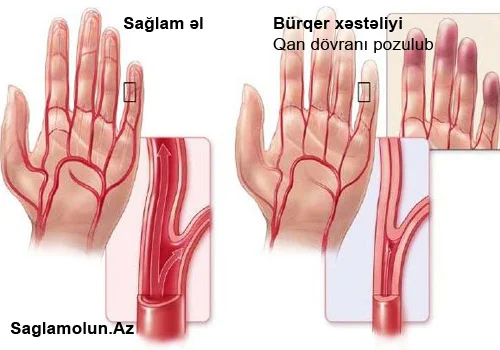 Siqaret çəkənlər mütləq oxusun! Bürqer xəstəliyi