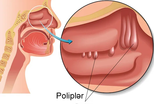 Burun polipləri. Simptomlar, səbəblər, müalicə