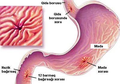 Xora xəstəliyinin simptomları