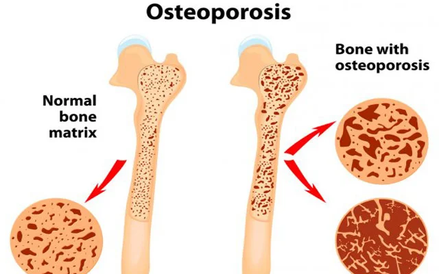 OSTEOPOROZ. Səbəblər və profilaktik tədbirlər