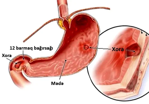 Mədəsi xəstə olanlar belə qidalanmalıdır. Vacib QAYDALAR