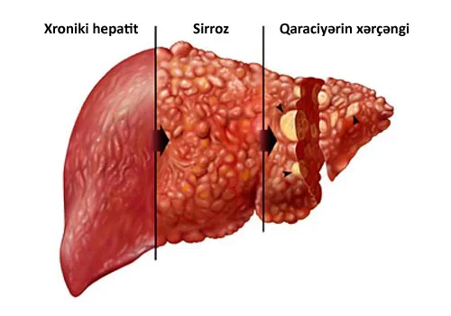 Qara ciyərin köçürülməsi. MARAQLI BİLGİLƏR