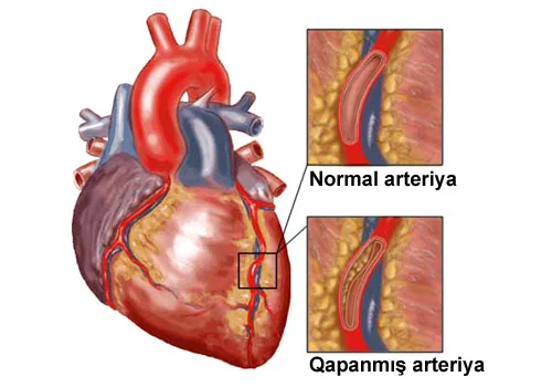 Ürəkdamar xəstəliklərindən özünü necə qorumaq olar?