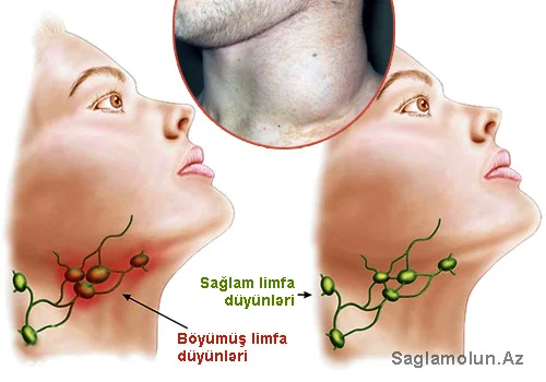 Limfa düyünləri böyüyübsə, həkimə müraciət edin. Bu xərçəng ola bilər!