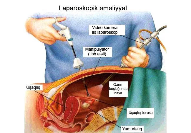 Yumurtalığın həqiqi kistaları