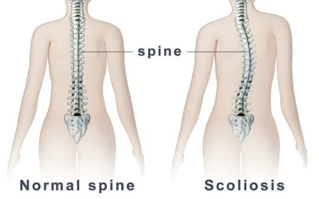 Skolyoz nədir və necə müalicə olunur?