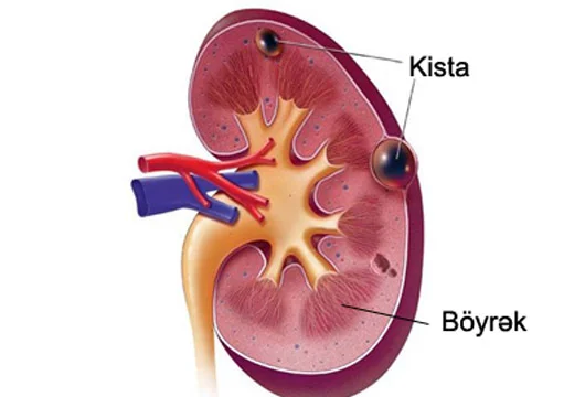 Böyrək kistaları