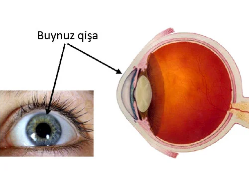 Keratit gözün buynuz qişasının iltihabı