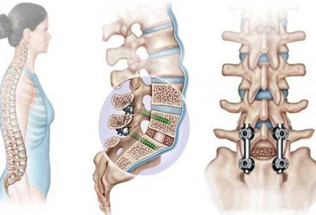 Onurğa implantı əməliyyatı nədir və nə zaman tətbiq olunur?