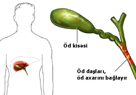 Xolesistit öd kisəsi iltihabı