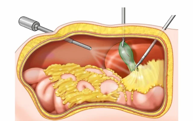 Öd daşı xəstəliyinin CƏRRAHİ MÜALİCƏSİ