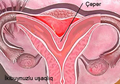 İkibuynuzlu uşaqlıq və hamiləlik