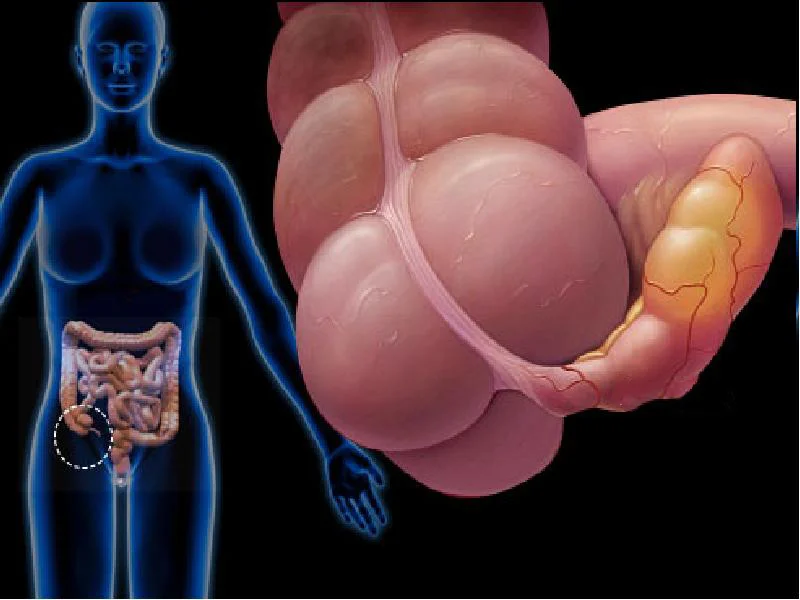 Appendisitin simptomları: Partlaması ölüm riski daşıyırmı?