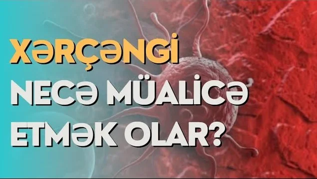 Xərçəngi necə müalicə etmək olar?