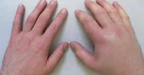 Əlləriniz tez tez şişir Nəyi yoxladaq?