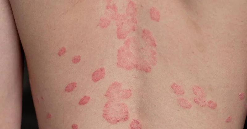 Beldəki səpkilərin yaranma səbəbi açıqlandı