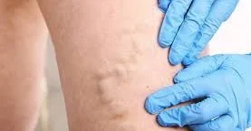 Ayaqlarda tromblar Necə bilinir?