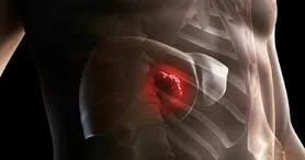 Güclü bel ağrısı qaraciyər xərçəngindən ola bilər