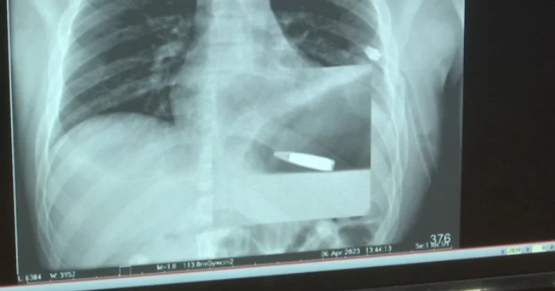 Ürəyinə güllə keçən kişi əməliyyat olundu