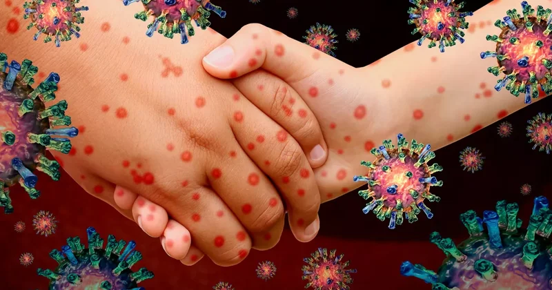 Ситуация с корью в Казахстане: заявление Минздрава