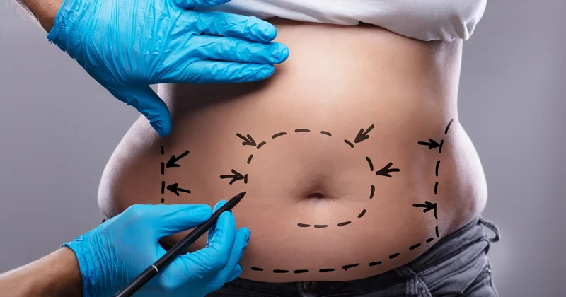 Bakıda abdominoplastika əməliyyatından sonra ölüm: Araşdırma aparılır