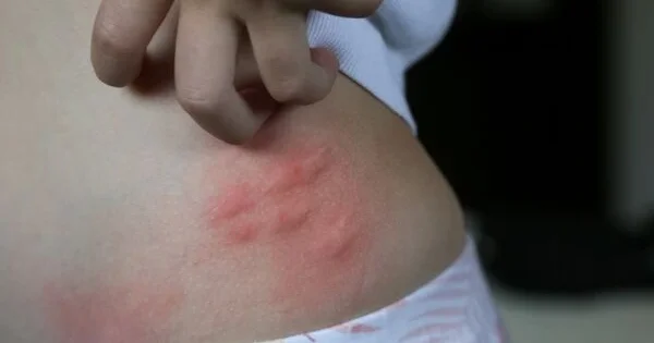 Hansı həşərat dişləyib? Mütəxəssislər ən çox rast gəlinən təhlükəli dişləmələri açıqladı