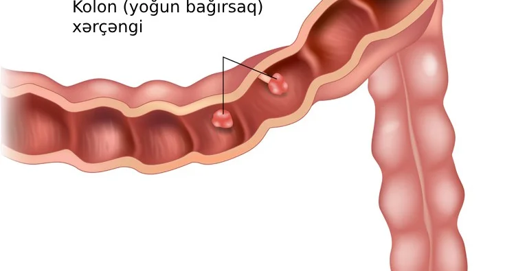 Bu qidalar bağırsaq xərçənginə səbəb olur ADLAR