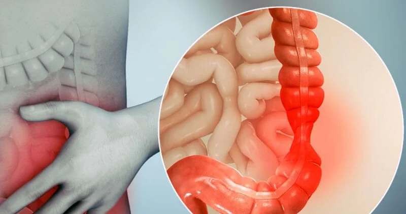 Hemoroid bildi, xərçəng çıxdı